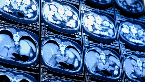 A 15-Minute Scan Can Catch Lung Cancer Early – Before It Spreads post