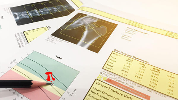 Bone Density Test: What Disorders Can It Diagnose? post