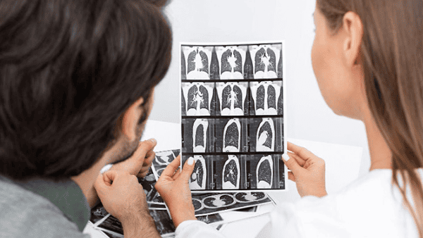 The Role of CT in Diagnosing Lung Nodules and What They Mean post